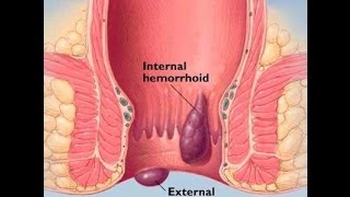 hemorrhoid and how to have normal bowel movement by doc willie ong