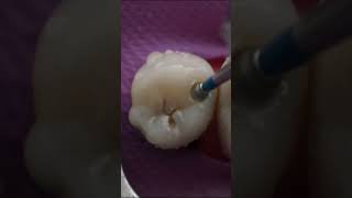 Never Ignore Pit and Fissure Caries #Small Tooth Cavity #shorts screenshot 1