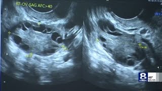 PCOS gets new name after nearly a century of confusion