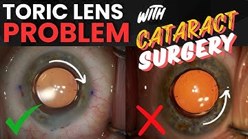 Toric Lens in WRONG Position after Cataract Surgery - What to do?