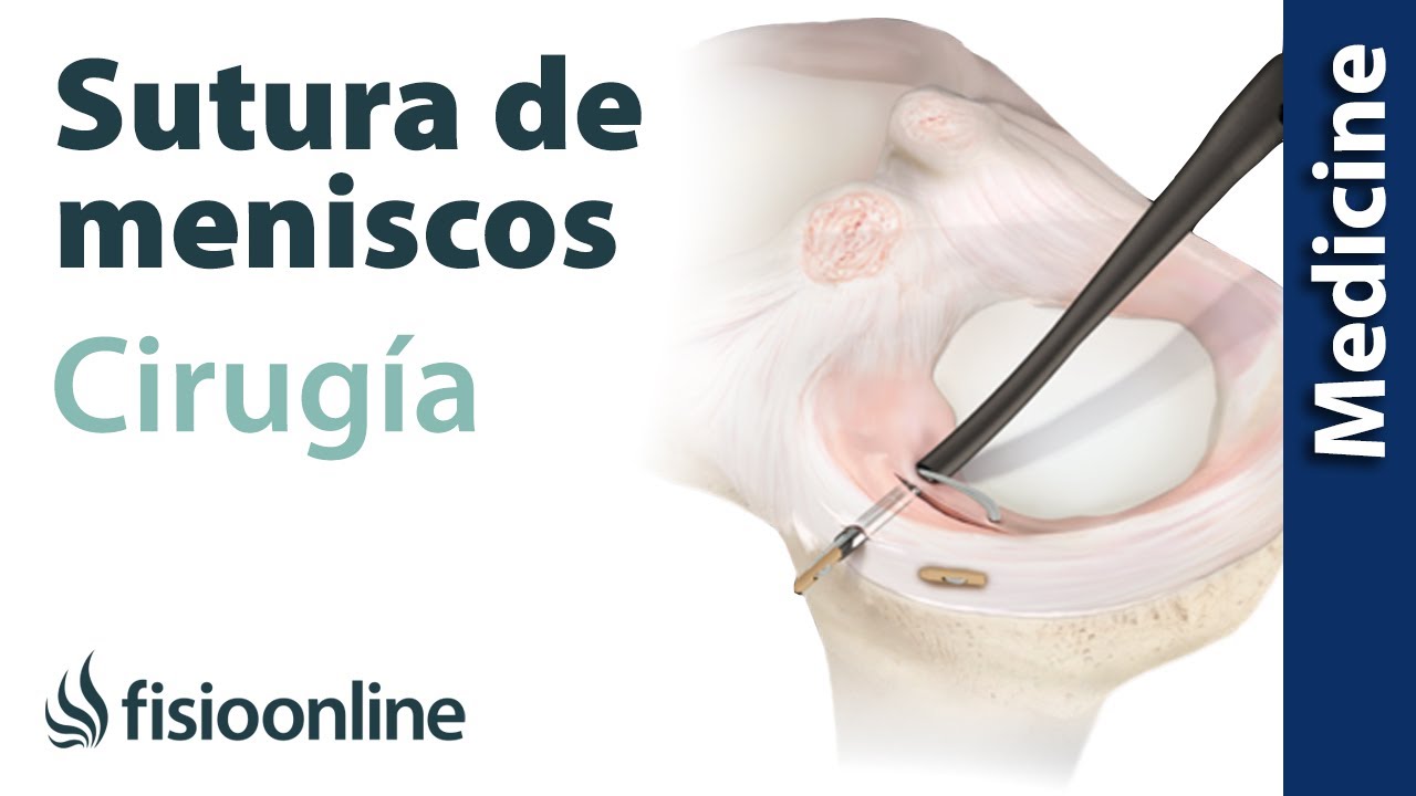 CIRUGÍA de reparación de MENISCO