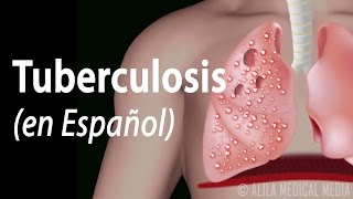 Tuberculosis: Progresión de la Enfermedad, Animación. Alila Medical Media Español.