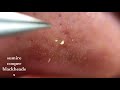 鼻角栓119nose blackheads★Tweezers only★