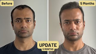 5 Month Update for Hair Transplant | 5200 grafts from Istanbul Turkey