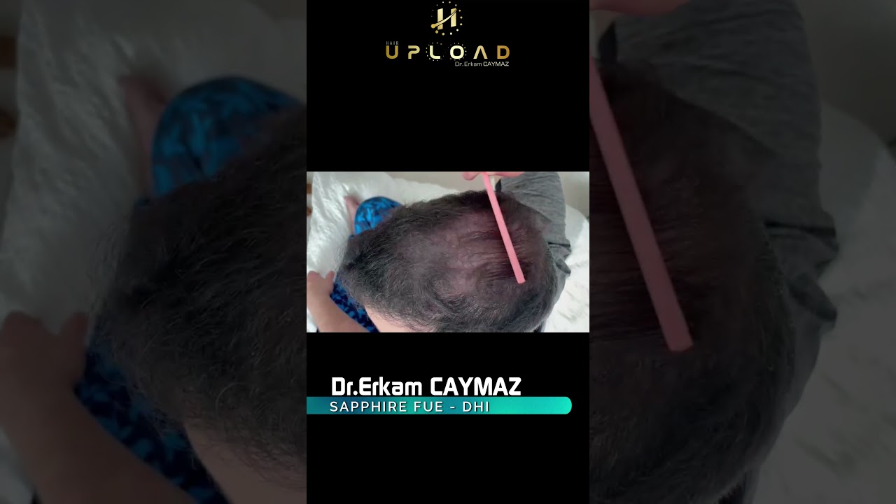 Hair Implantation and Beard Fixing