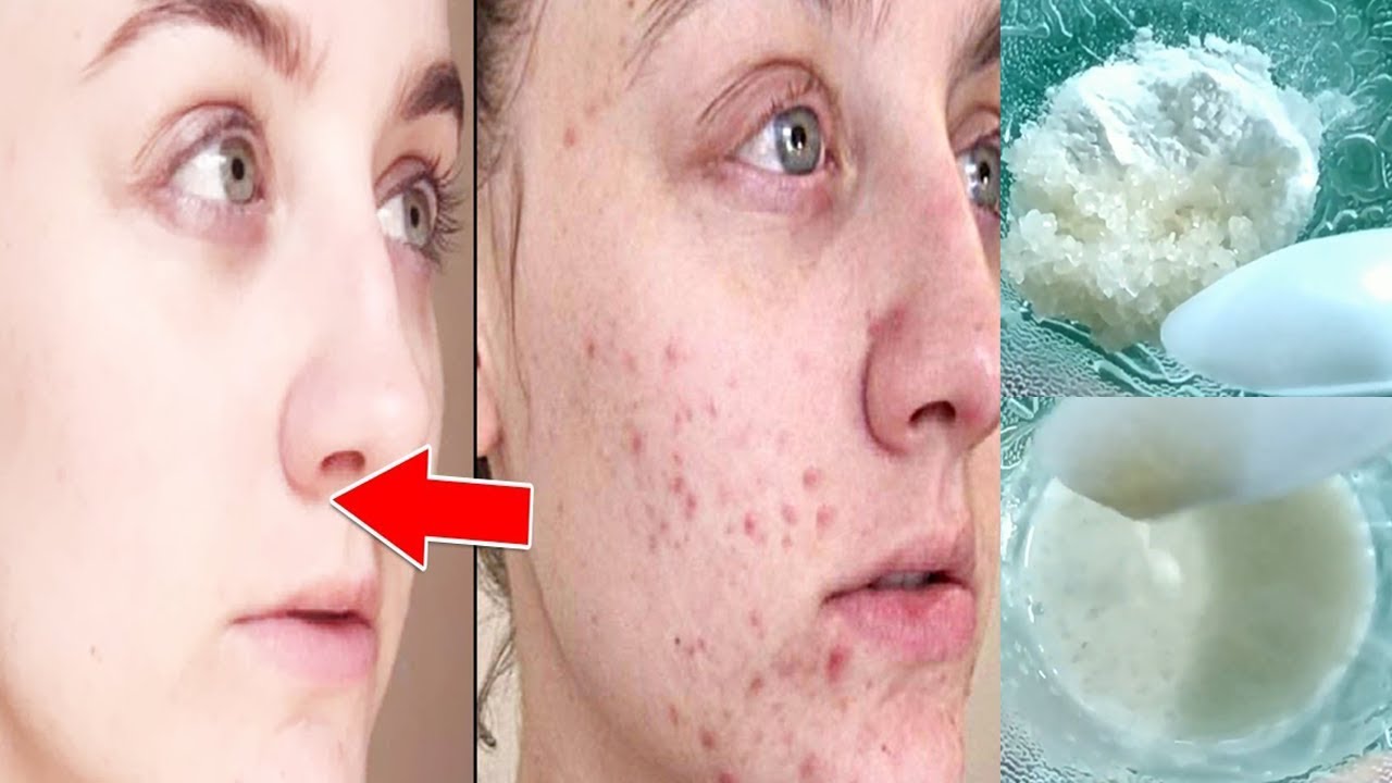 Annoying Acne Scars Overcome With A Natural Sugar Scrub Permanently Annoying acne scars overcome with a natural sugar scrub permanently
