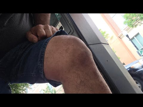Knee injections of hydrochloric acid life changing for me first shot results
