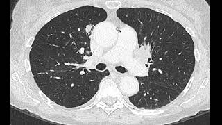 Metastatic colorectal cancer to the lungs