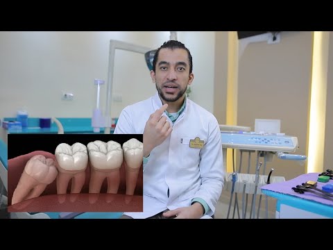 فيديو: هل يشمل ترقيم الأسنان ضرس العقل؟