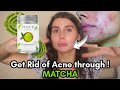 How I Clear My Skin With Matcha :) All of  the benefits to get rid of acne