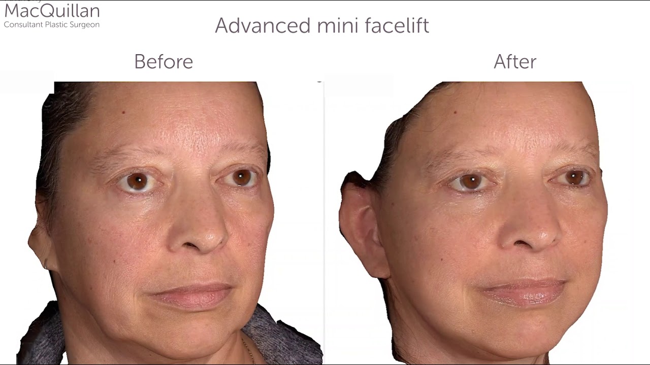 Facelift Before and After - YouTube