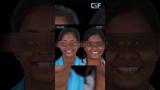 Indias First 3D Printed Smile Aligners Transform Your Smile With Cdf Coimbatore