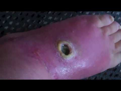 Spider Bite Wound After Three Months-Caution-Disturbing To Watch
