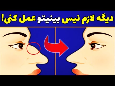 تصویری: 3 روش ساده برای درمان بینی شکسته