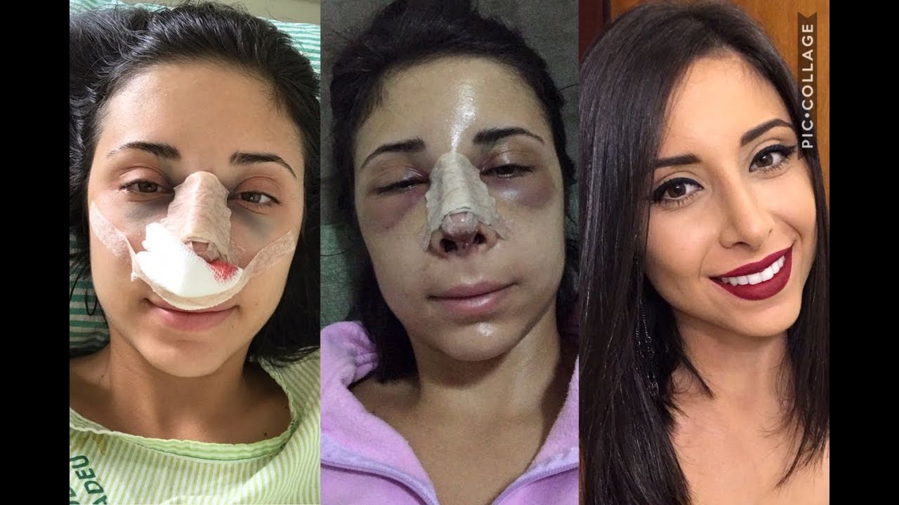 MINHA RINOPLASTIA! Vlogs do Pós Operatório - YouTube