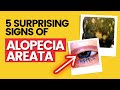 How To Tell If You Have Alopecia Areata (MUST WATCH)