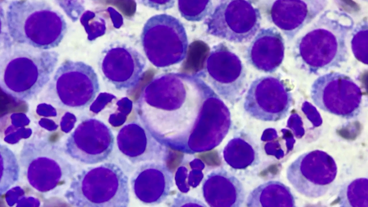 Tarlette Cell Tart cell in lymph node cytology - YouTube