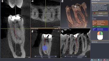 SICAT ENDO: Marking Root Canals in 3D