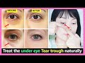 How to treat the under eye Tear trough, Get rid of Tear troughs in hollows naturally without fillers