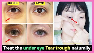 How to treat the under eye Tear trough, Get rid of Tear troughs in hollows naturally without fillers