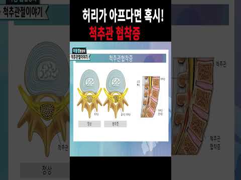척추관협착증이란?
