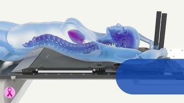 The Radixact® System, the Most Comprehensive Breast Cancer Treatment System