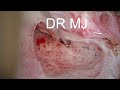 RIGHT COCHLEAR IMPLANTATION USING ULTRA SLIM-J ELECTRODE AND DEMONSTRATION OF STAPEDIAL REFLUX