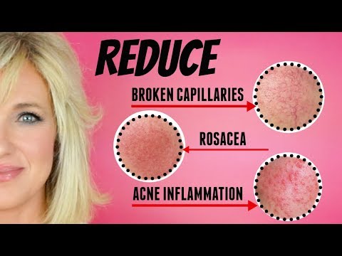 REDUCE Facial Redness, Broken Capillaries, Rosacea & Acne Inflammation!