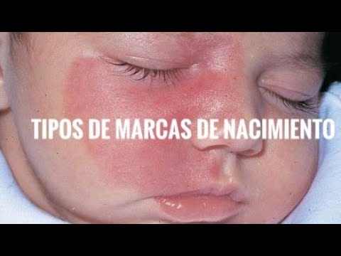 TIPOS DE MARCAS DE NACIMIENTO