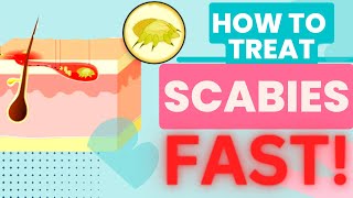 HOW TO TREAT SCABIES FAST! TREATMENT AND HOME REMEDIES