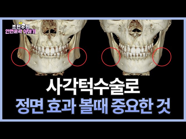사각턱 유형별 정면에서 수술 효과 보는 법 │ 뻗친 턱뼈 vs 말린 턱뼈