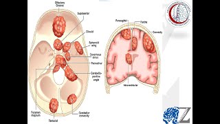 Brain Tumours (28):  Meningiomas (2)  الورم السحائي بالمخ