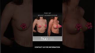Before and After Breast Augmentation - Dr Guncel Ozturk #guncelozturk #drgo