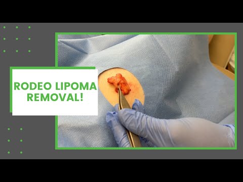 Rodeo Lipoma Removal! | Dr. Derm