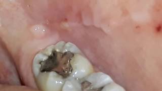 Scar From Cheek Biting Youtube