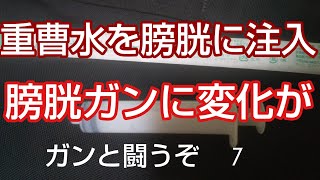 ❪重曹水を膀胱に注入❫ 膀胱癌を６回手術 次は摘出と言われ 重曹水をを膀胱に直接注入 カテーテルと注射器を使い膀胱を洗浄 すると大きな変化が！！