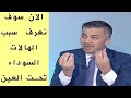 شرح مبسط لأسباب السواد حول العينين 