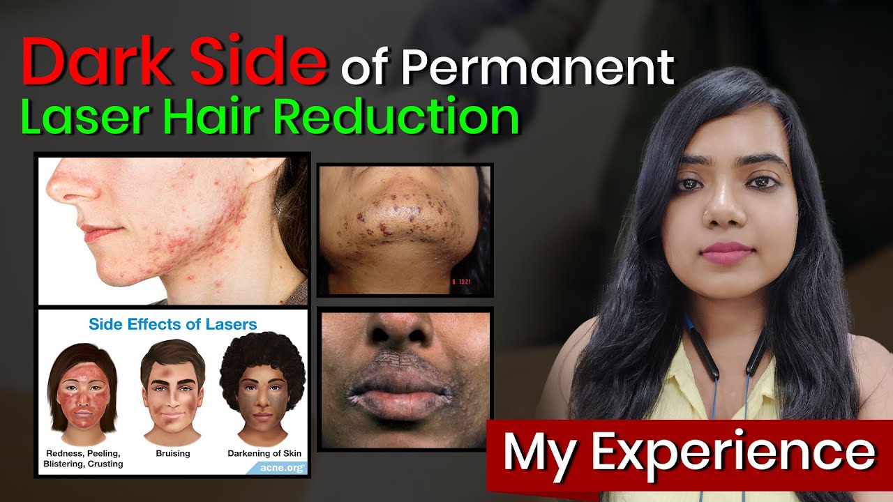 Is Laser Hair Removal Truly PERMANENT? Review of Permanent Laser Hair Removal Cost in India | VLCC