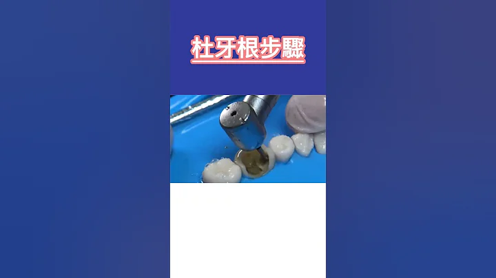 杜牙根步驟拆解，拆解牙髓治療過程 - 天天要聞