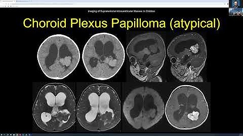 Pediatric Intraventricular Masses  - Dr. Fabricio Goncalves -- 12.11.12025