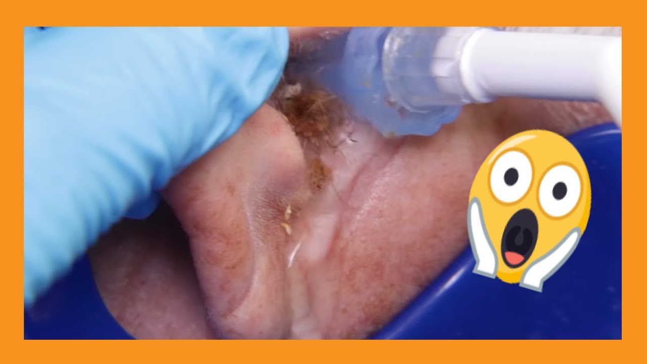 Blocked Ear Cleaning Marathon | Auburn Medical Group - YouTube