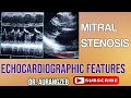 Mitral Stenosis Simplified | Echocardiographic Features Clip 2 With Discussion