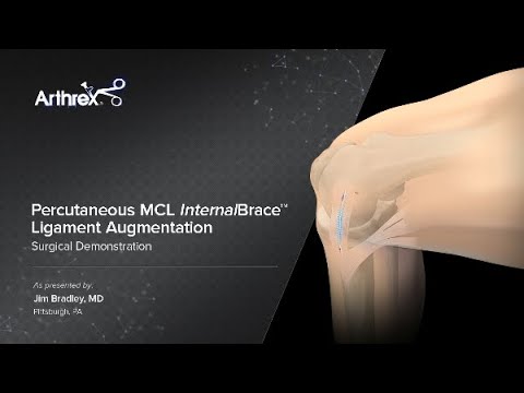 Percutaneous MCL InternalBrace™ Ligament Augmentation