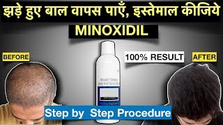 MINOXIDIL for Hair Regrowth in Hindi | Know How To Apply Correctly