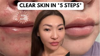 5 Step Acne Skincare Routine (AM & PM) | How I Got Rid of Acne, Scars, Texture (2024)