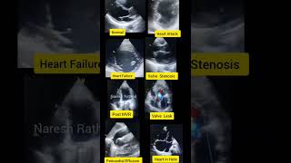 Normal Echo vs Abnormal Echo | Heart Attack | Naresh Rathod #heartattack #humanheart
