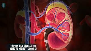 Kidney Stones Removal Laser Surgery Simulation Game