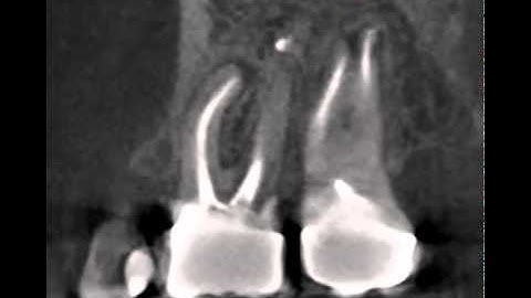 Cone Beam CT shows lesion on upper molar