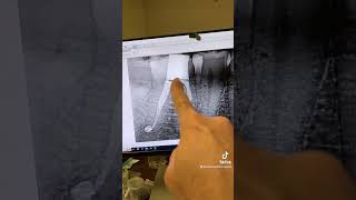 RCT of a cracked tooth #30.