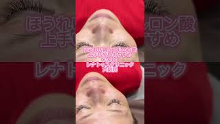 ほうれい線ヒアルロン酸と鼻翼基部ヒアルロン酸上手い安いおすすめならレナトゥスクリニック